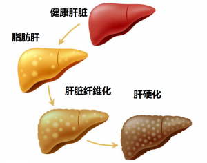 酒精肝,酒精肝症状,肝硬化,喝酒,酒精性脂肪肝,酒精性肝炎,酒精性肝硬化