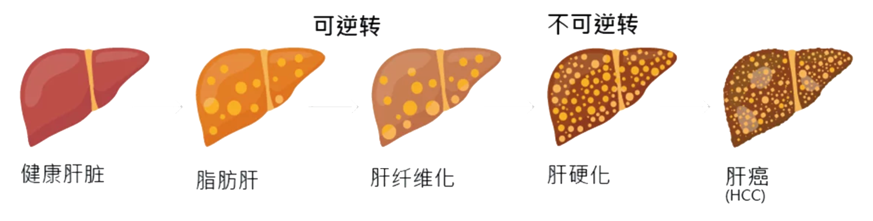 脂肪肝,肝癌,肝硬化,肝炎,脂肪肝症状,肝炎症状,肝硬化症状,肝脏疾病症状,肝纤维化,脂肪肝治疗,肝功能检查,肝癌治疗,肝硬化治疗,肝炎治疗,肝癌症状,酒精肝症状,肝功能检测,肝脏疾病,肝纤维化治疗,肝炎检查,肝硬化检查,肝癌检查,肝纤维化检查,脂肪肝检查,肝纤维化扫描,脂肪肝b超,脂肪肝怎么检查,肝硬化b超,肝纤维化扫描费用,脂肪肝如何检查,肝病检查,肝脏检查,肝功能检查费用,肝功能体检,肝脏体检,体检肝功能,脂肪肝体检,体检脂肪肝,脂肪肝检测,肝纤维化检测,肝硬化检测,肝纤维化症状,肝功能症状,肝科,肝胆科,肝脏专科,肝科医生,肝胆科医生,肝脏专科医生,肝科诊所,肝胆科诊所,肝脏专科诊所